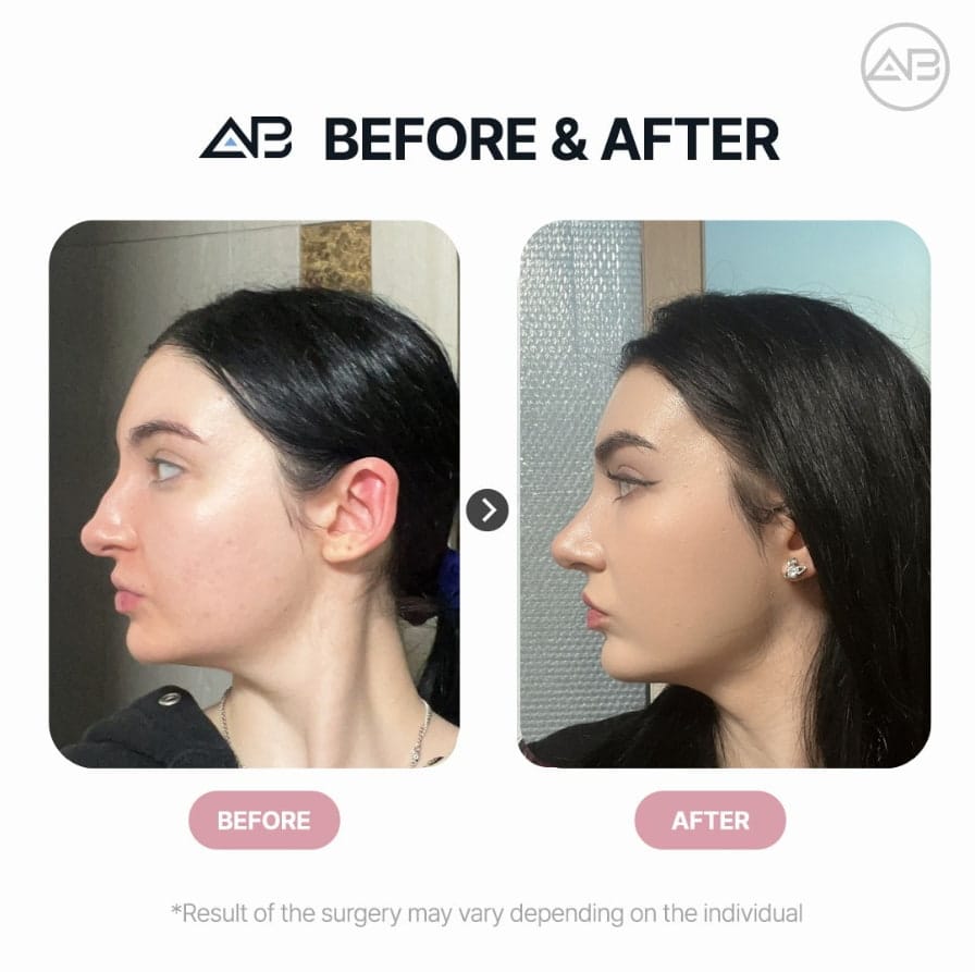 AB Plastic Surgery Seoul Rhinoplasty- Before After