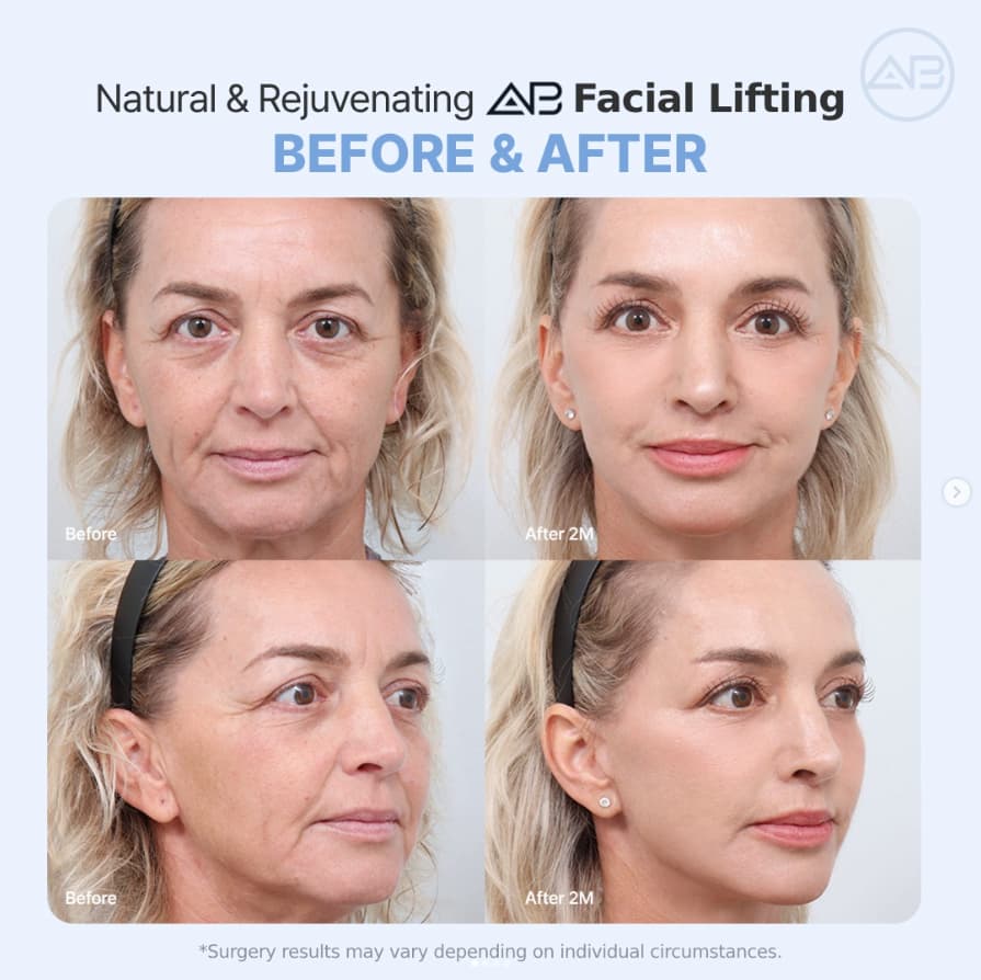 AB Plastic Surgery Seoul Facial Lifting-Before After