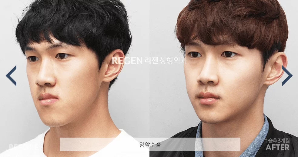 double jaw two korea seoul plastic surgery before and after