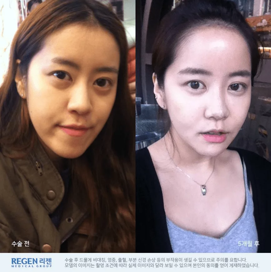 double jaw two korea seoul plastic surgery before and after